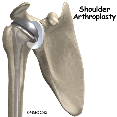 Artificial Joint Replacement of the Shoulder