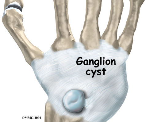 Ganglions of the Wrist