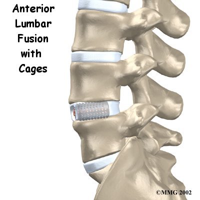 Anterior Lumbar Fusion with Cages